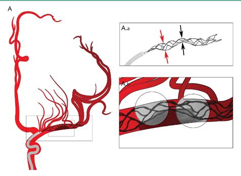lereis|Mechanical Thrombectomy in Patients with Acute Ischemic .